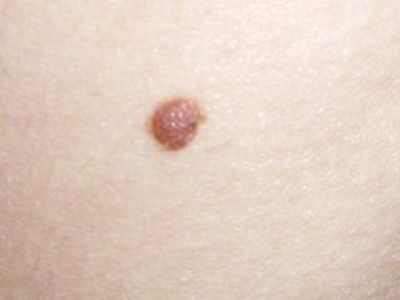 Меланому можно будет диагностировать с помощью анализа крови
