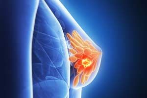 Новый метод лечения рака груди спас смертельно больную женщину