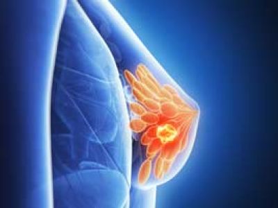 Новый метод лечения рака груди спас смертельно больную женщину